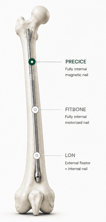 Femur bone with a fully internal Precice magnetic nail